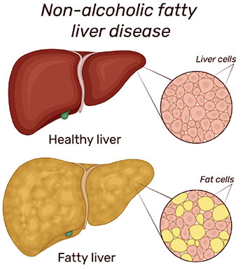 Non-alcoholic fatty liver: the twin of diabetes – The Island